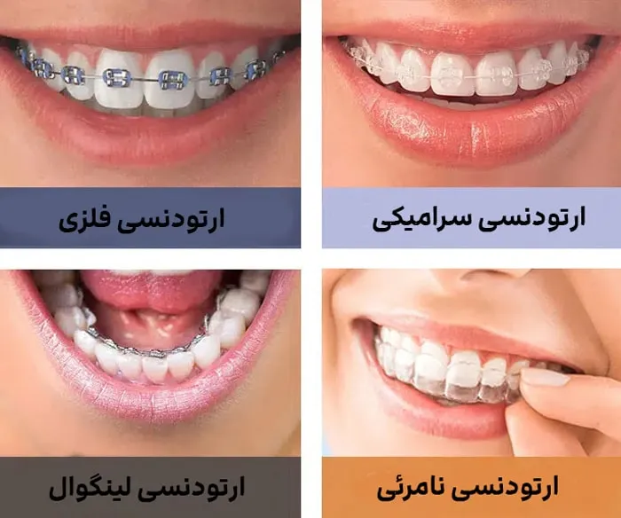 پیرسینگ و ارتودنسی