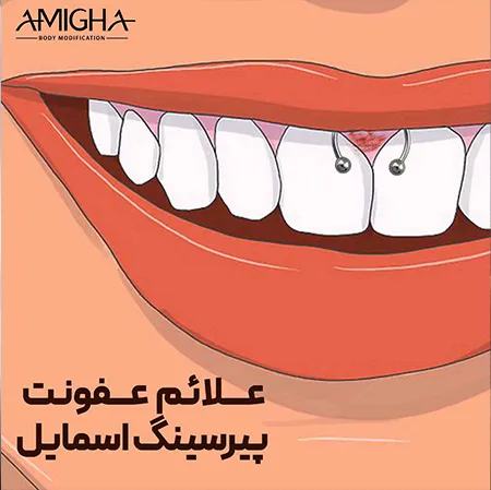 علائم عفونت پیرسینگ اسمایل