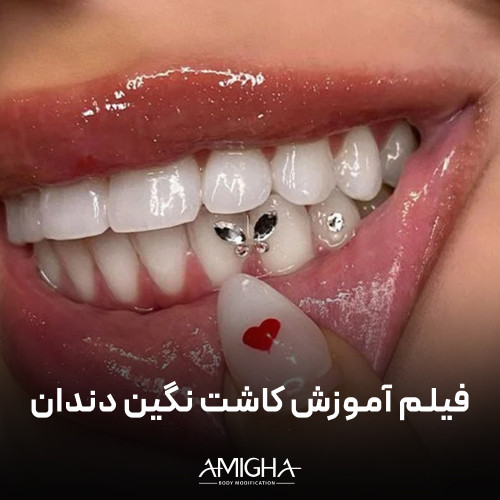 فیلم آموزش کاشت نگین دندان