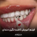 فیلم آموزش کاشت نگین دندان
